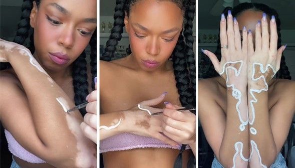El valor del arte: joven transforma el vitiligo en su proyección de belleza